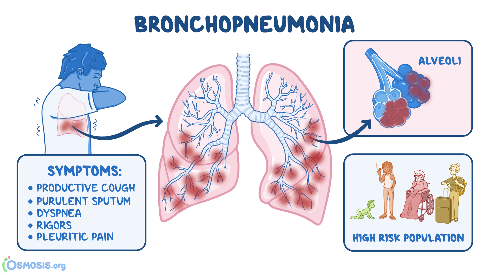 Bronchopneumonia.png